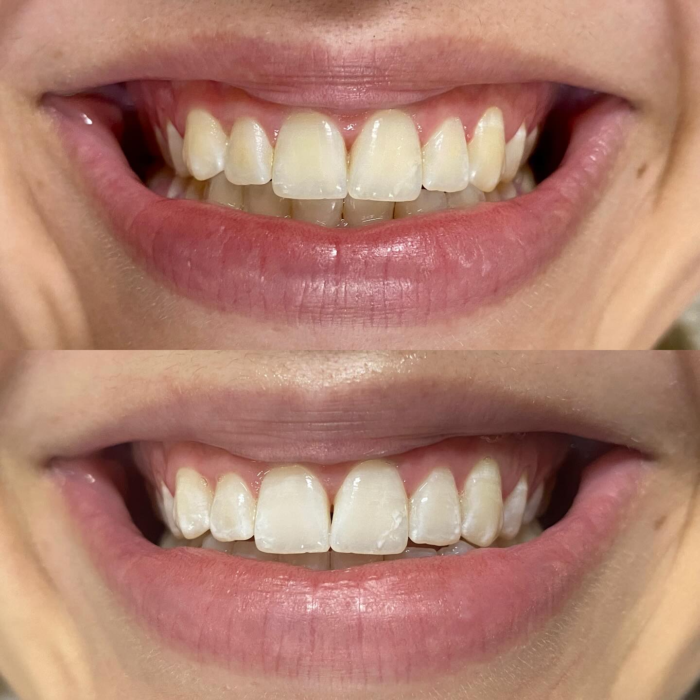 Antes e depois de clareamento dental