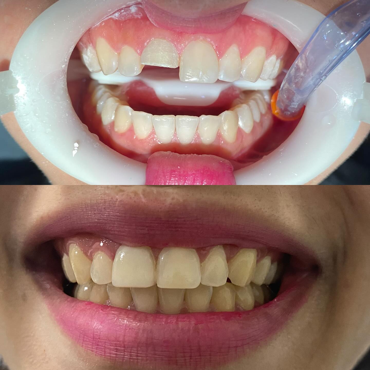 Antes e depois de restauração estética em dente fraturado