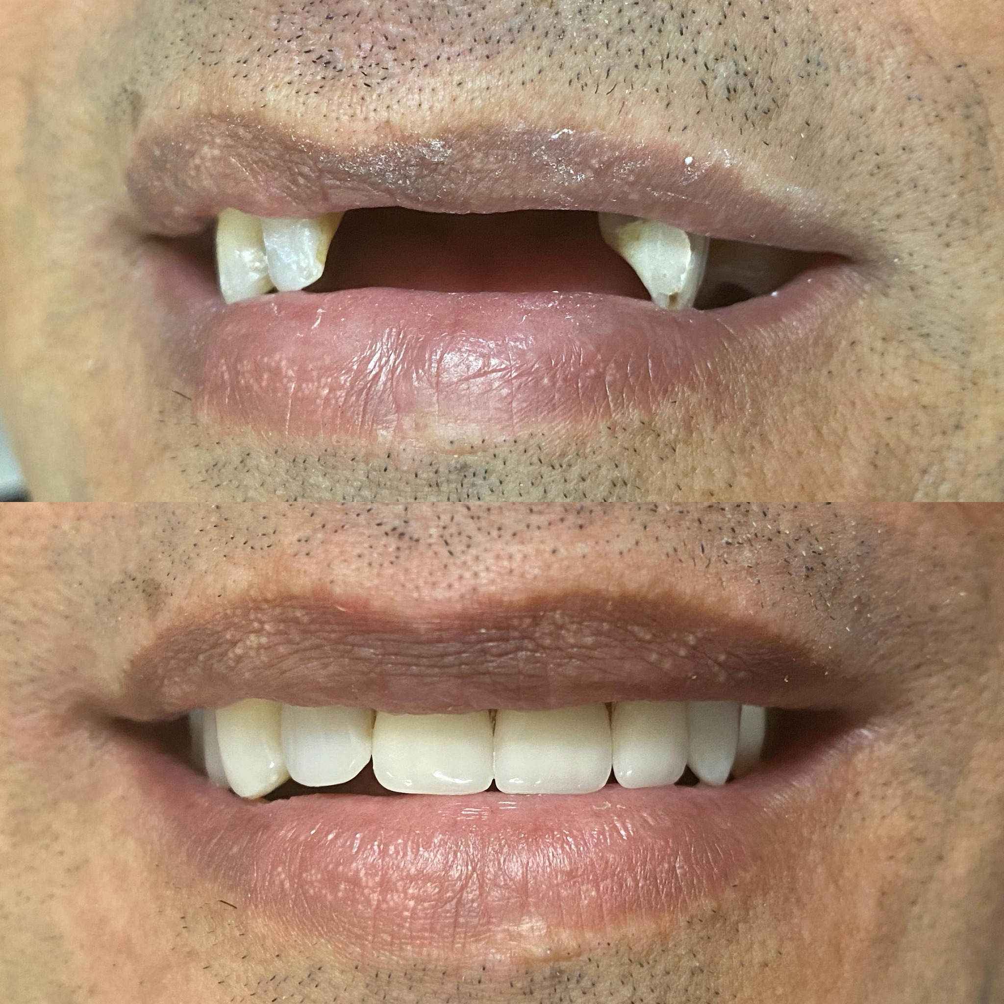 Antes e depois de reabilitação oral